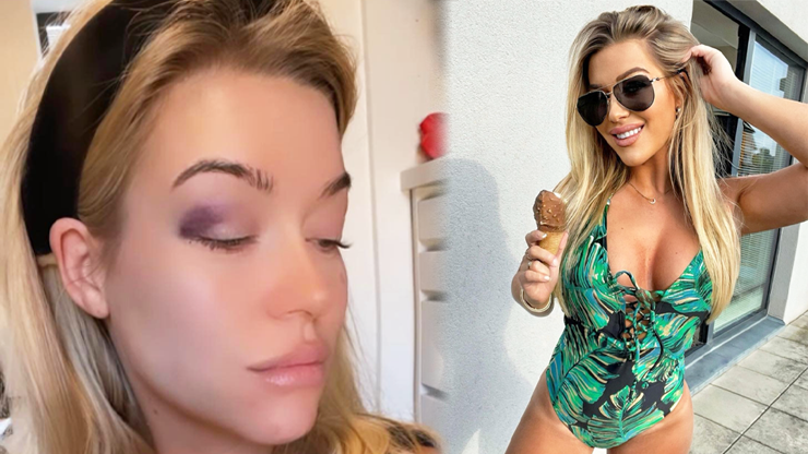 Narozeninová party se zvrtla a létaly lokty: Odnesla to Dominika Myslivcová s obřím monoklem přes oko, co se stalo?