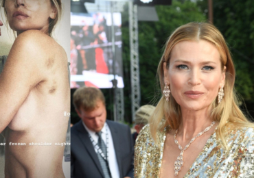 Topmodelka Daniela Peštová trpí v bolestech: Děsivými modřinami má poseté celé tělo