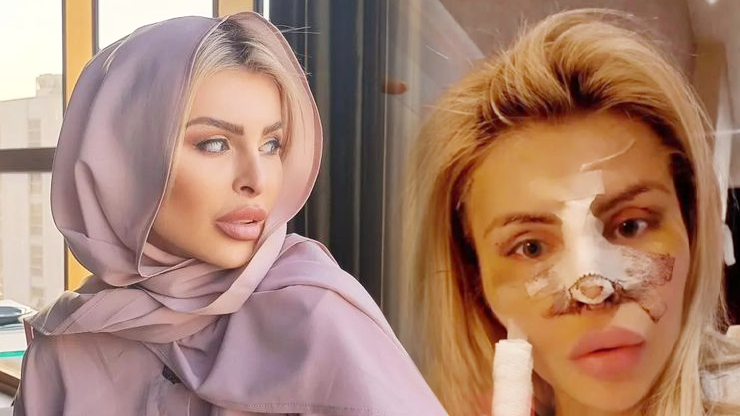 Bolestivá plastika Lely Vémoly v Íránu: Finální výsledek až za několik měsíců