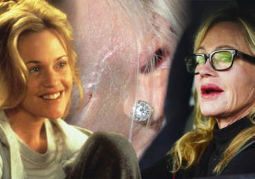 Melanie Griffith ukázala ošklivou jizvu po rakovině kůže: Pro všechny, kteří se rádi opalují, má jasný vzkaz