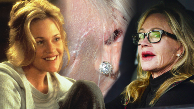 Melanie Griffith ukázala ošklivou jizvu po rakovině kůže: Pro všechny, kteří se rádi opalují, má jasný vzkaz