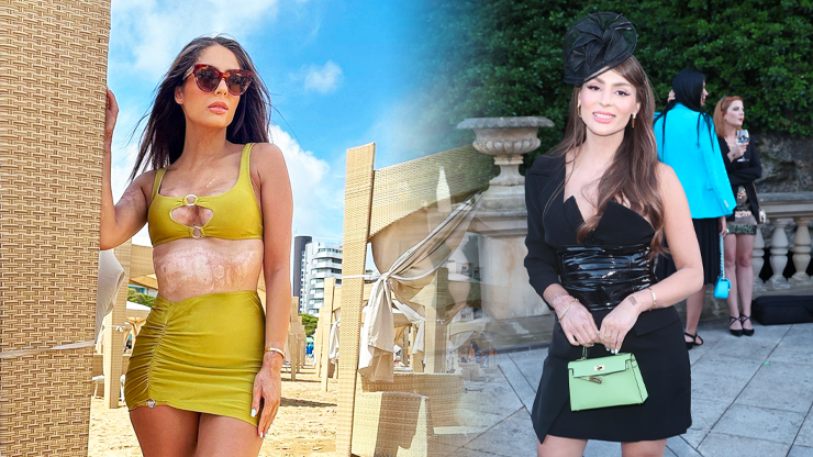 Týnuš Třešničková hrdě vystavuje své jizvy od popálenin: Ukázala se v bikinách a poslala dojemný vzkaz